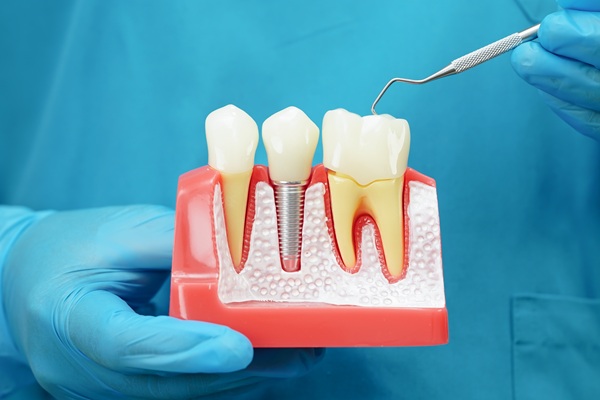 Prostheses Commonly Used With Dental Implants